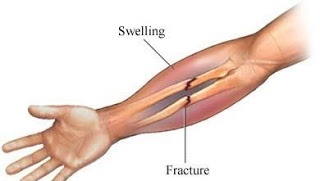 broken-bones ÙƒØ³Ø± Ø¨Ø³ÙŠØ·